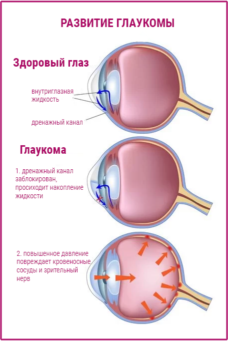 Диагностика глаукомы в Израиле